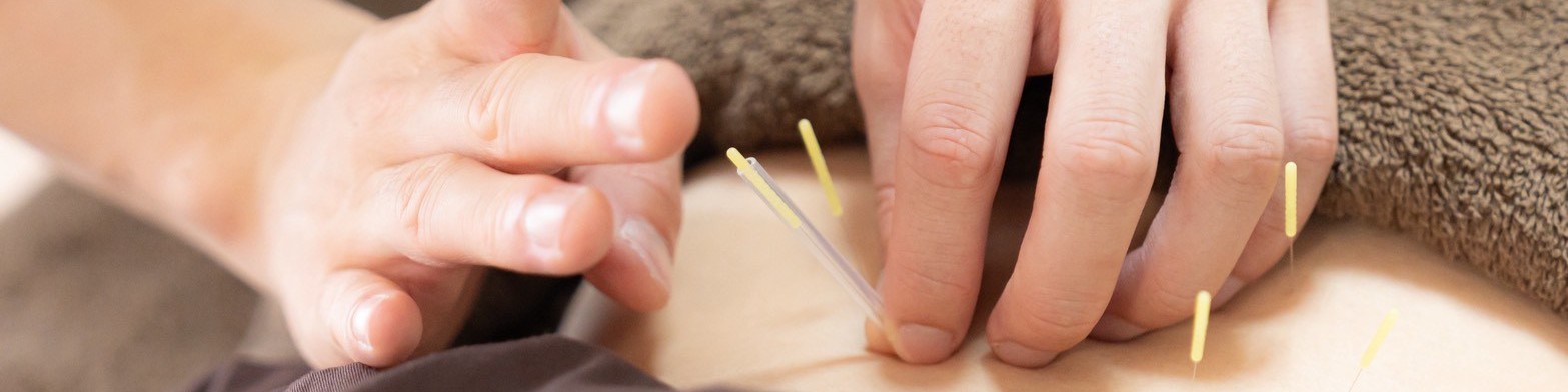 トリガーポイント鍼灸