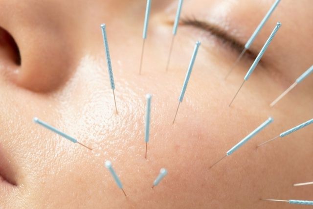 美容鍼