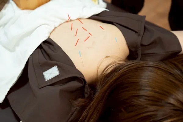 トリガーポイント鍼灸